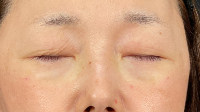 手术前的状态 其一