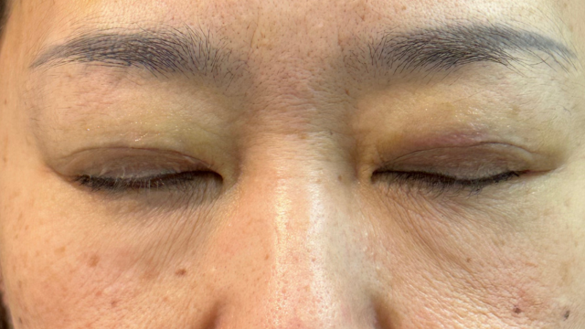 Postoperative Condition Part 1