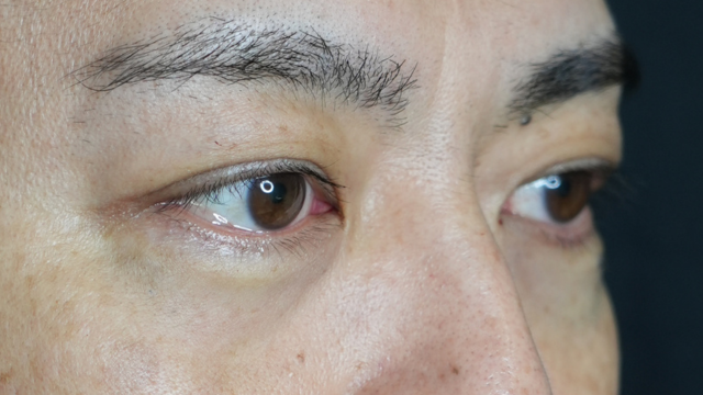 手術前の状態 その1