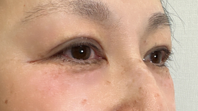 手术前的状态 其一