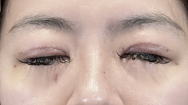 Postoperative Condition Part 1