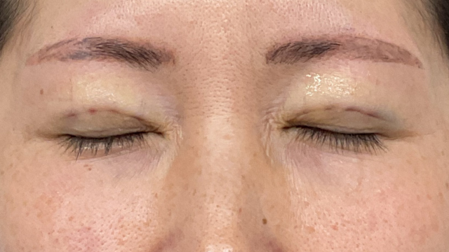 Postoperative Condition Part 1