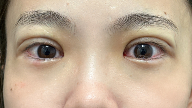 手术前的状态 其一