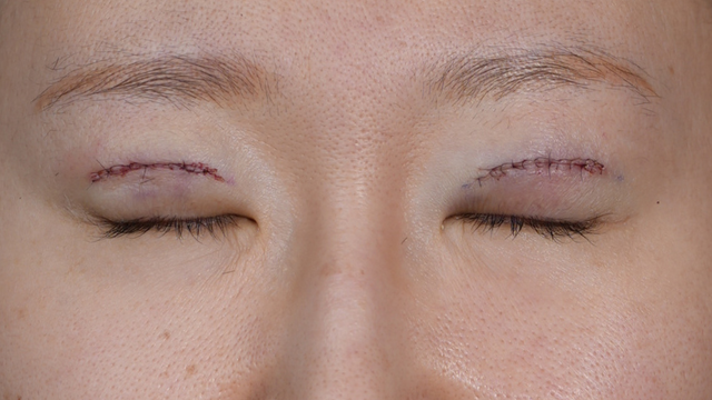 手术前的状态 其一