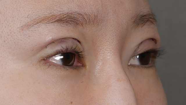 手術前の状態 その1