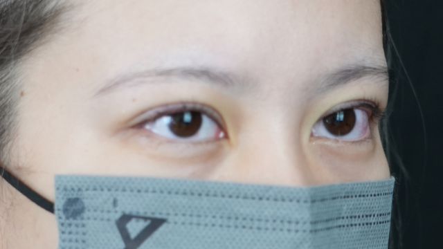 手術前の状態 その1