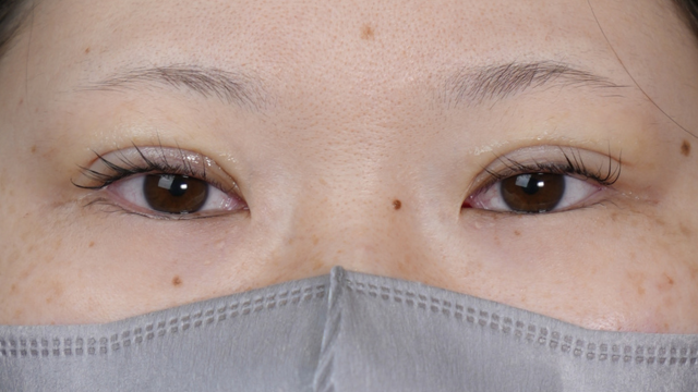 手术前的状态 其一