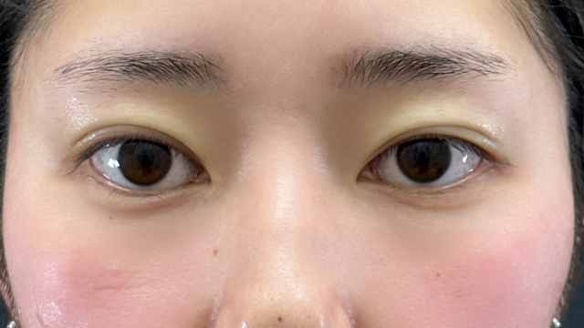 手術前の状態 その1