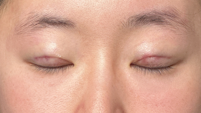 Postoperative Condition Part 1