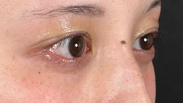 手术前的状态 其一