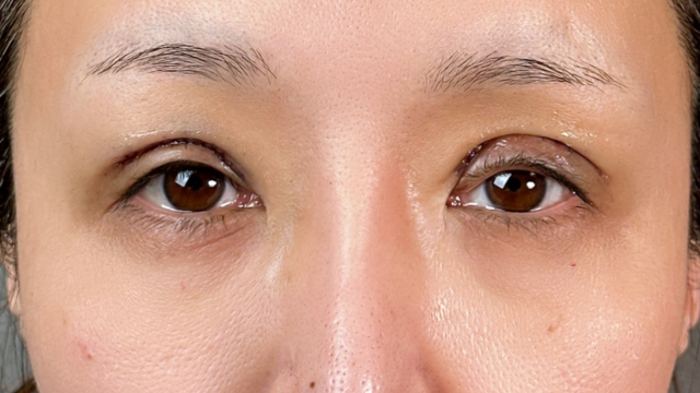 手術前の状態 その1