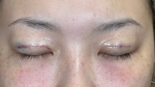 手术前的状态 其一