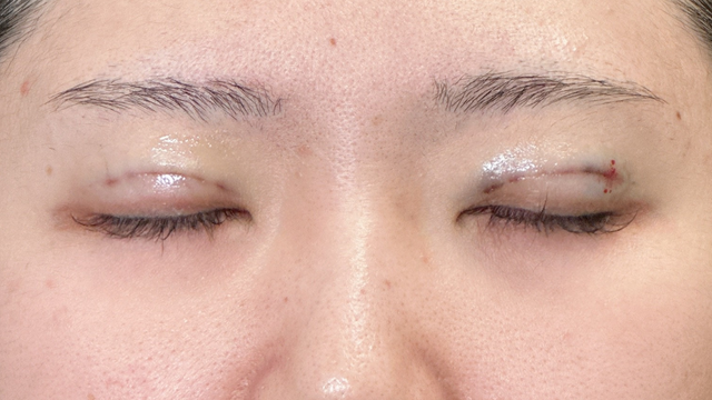 手术前的状态 其一