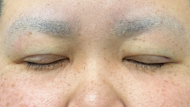 Postoperative Condition Part 1