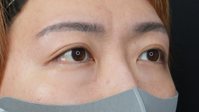 手术前的状态 其一