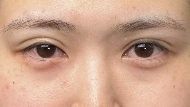 手术前的状态 其一