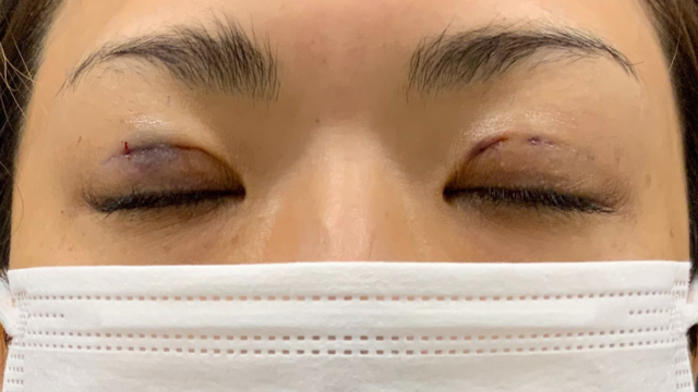 手術前の状態 その1