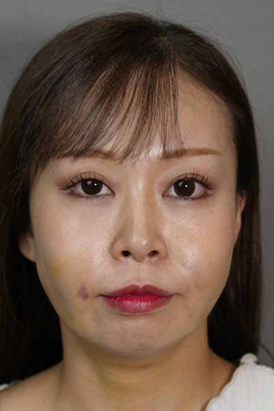 手术前的状态 其一