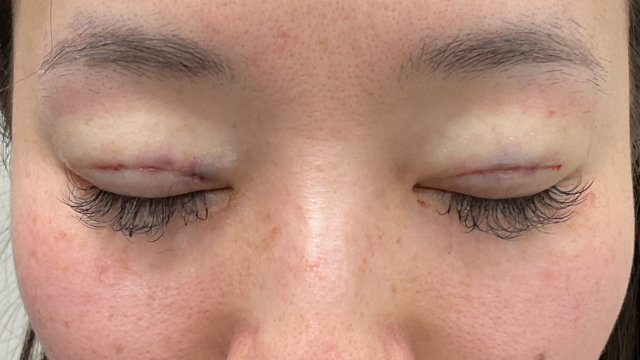 手术前的状态 其一