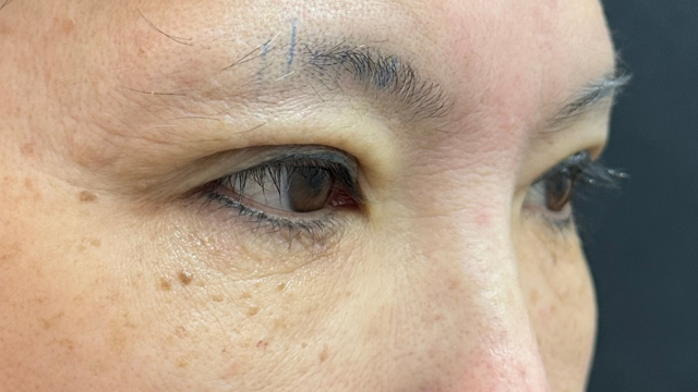 手術前の状態 その1