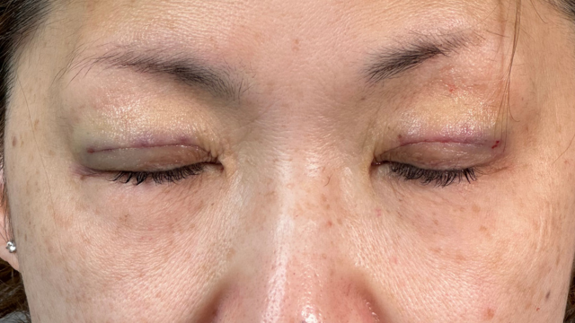 手術前の状態 その1