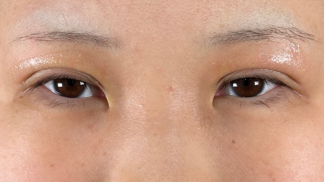 手术前的状态 其一