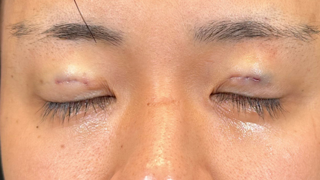 手术前的状态 其一