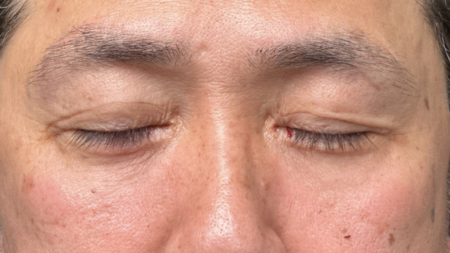 手术前的状态 其一