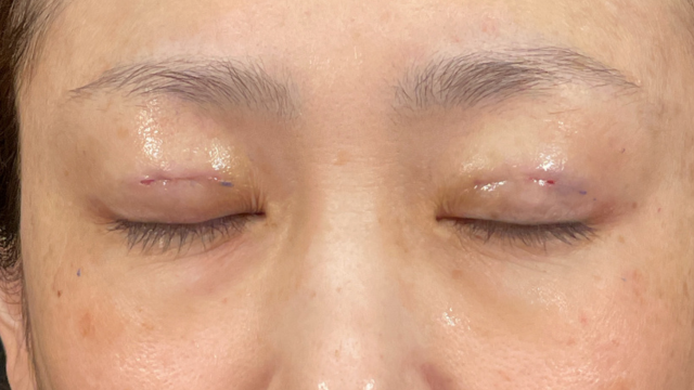 手術前の状態 その1