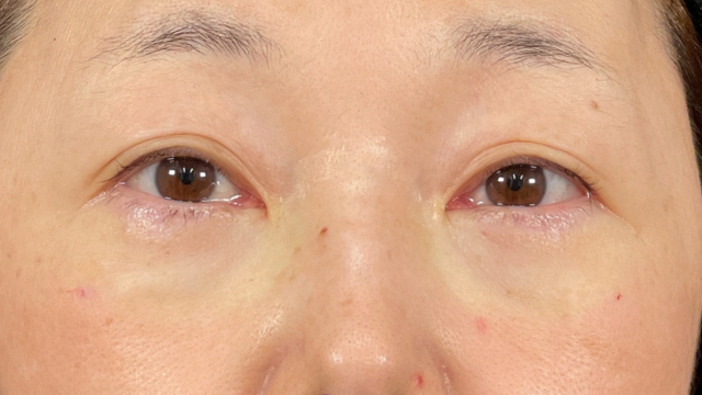 手术前的状态 其一