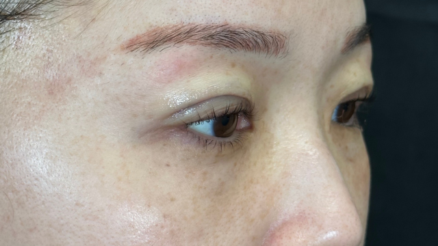 手術前の状態 その1