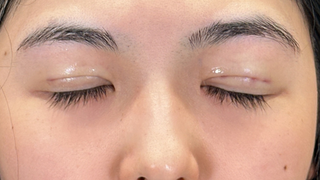 手术前的状态 其一