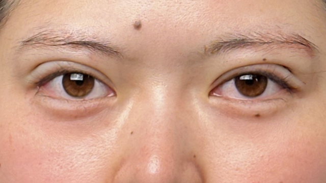 手术前的状态 其一