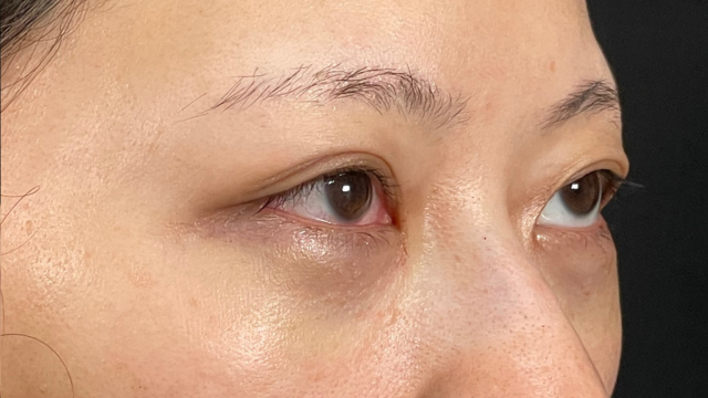 手术前的状态 其一