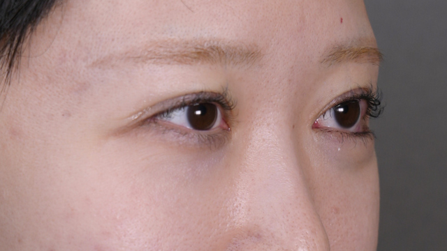 手术前的状态 其一