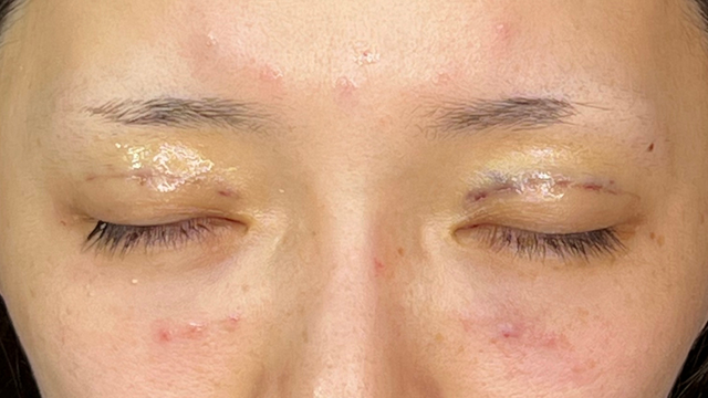 Postoperative Condition Part 1