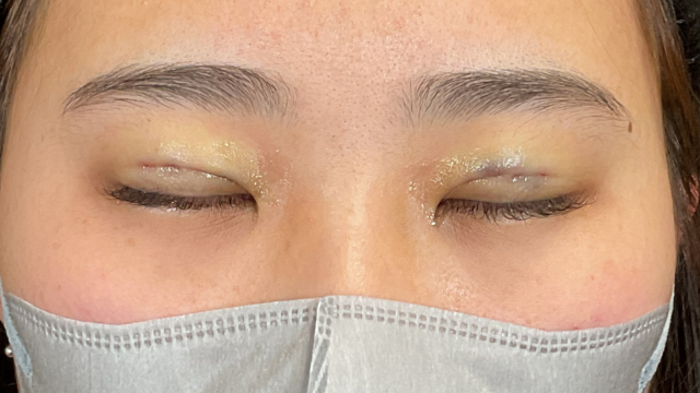 手术前的状态 其一