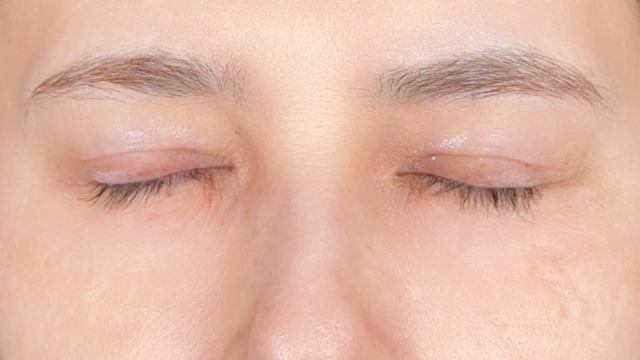 手术前的状态 其一