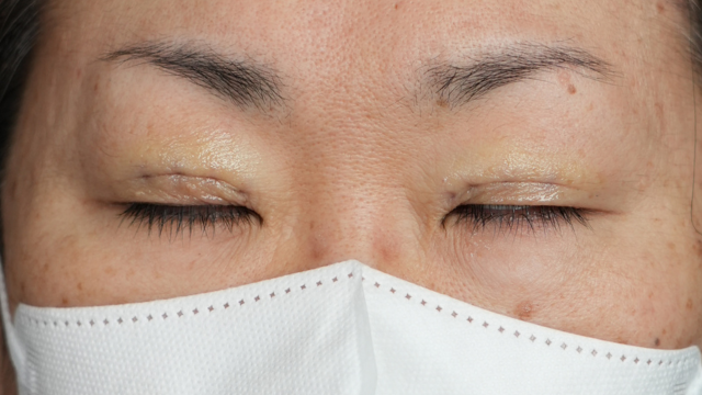 手術前の状態 その1