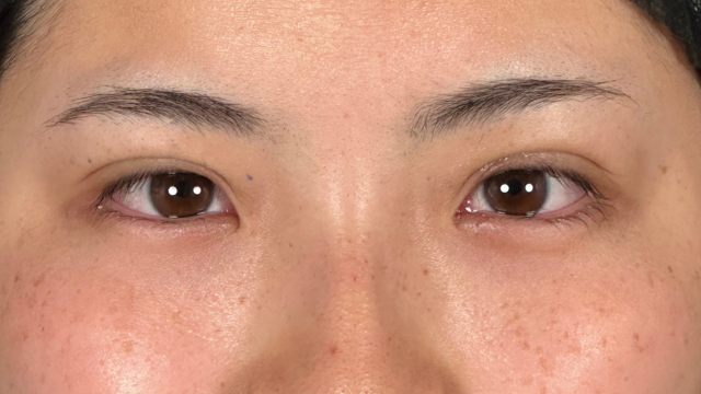 手术前的状态 其一