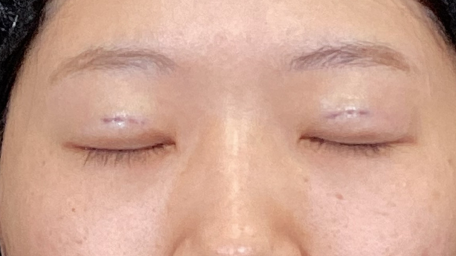 手术前的状态 其一