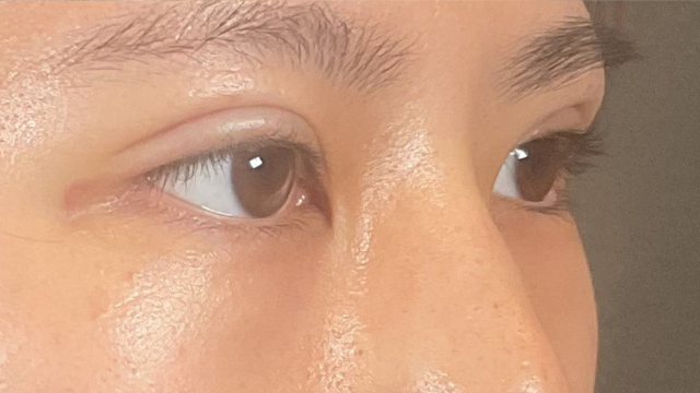 手術前の状態 その1