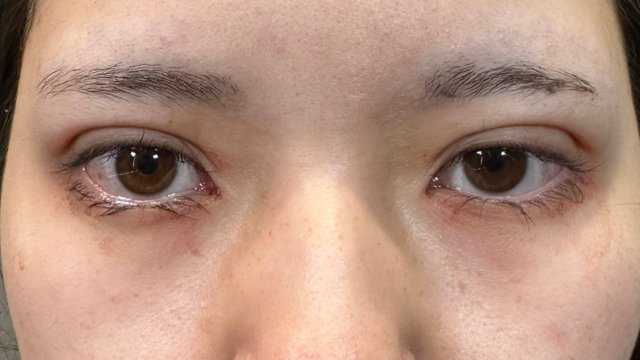 手術前の状態 その1