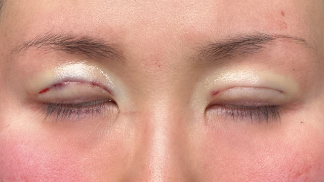 Postoperative Condition Part 1