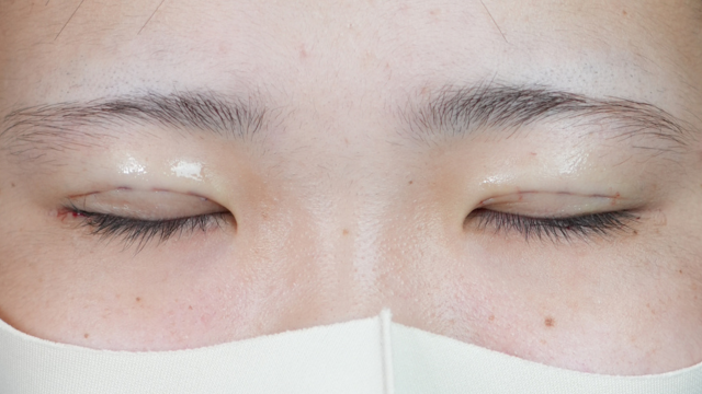 Postoperative Condition Part 1