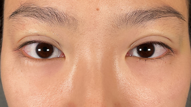 手术前的状态 其一