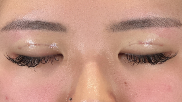 手術前の状態 その1