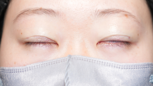 手術前の状態 その1