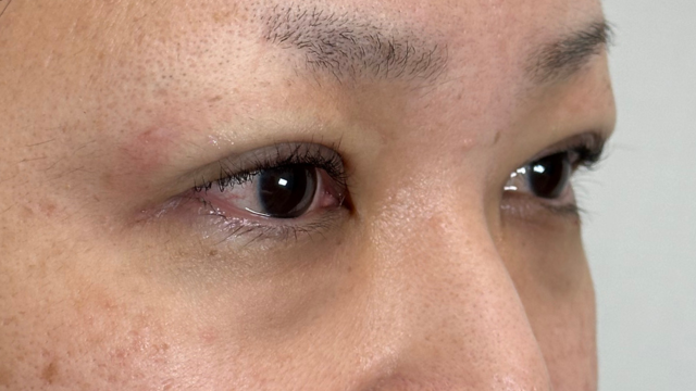 Postoperative Condition Part 1