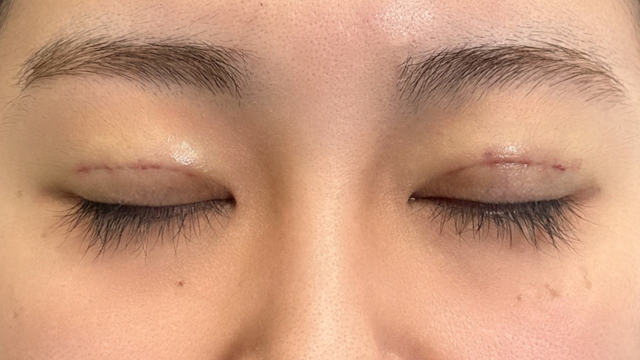 手术前的状态 其一